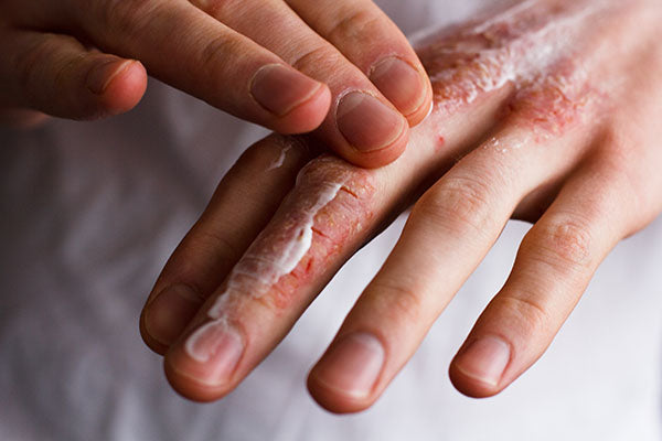 image of irritated hands with skin cream on it