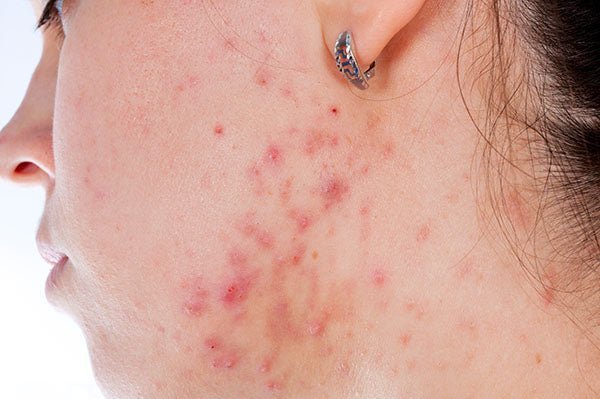 Serum for Acne Prone Skin - Aromantic UK