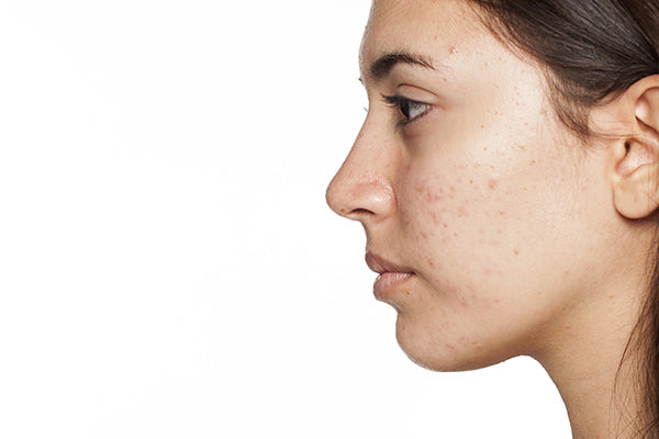 Image of Woman with Acne Prone Skin Suitable for Facial Serum