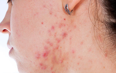 image of woman with acne