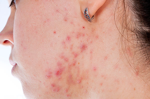image of woman with acne