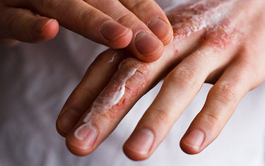 image of irritated hands with skin cream on it