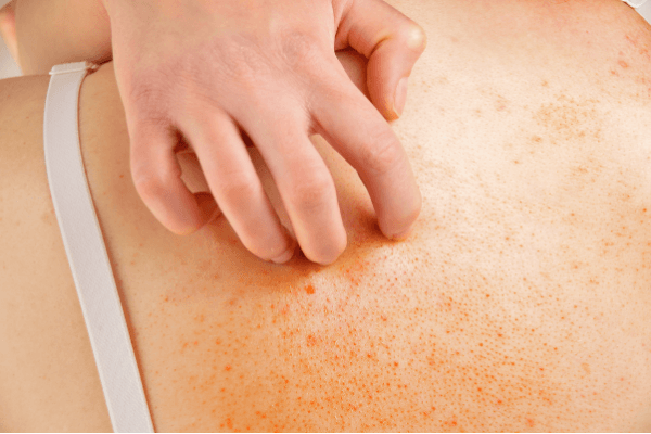 Body Gel for Itchy Skin Recipe